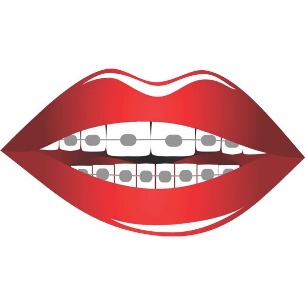 Lips Braces 2 Thumbnail